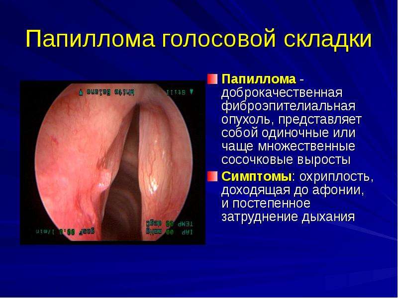   Папиллома голосовой складки
Папиллома - доброкачественная фиброэпителиальная опухоль, представляет собой одиночные или чаще множественные сосочковые выросты
Симптомы: охриплость, доходящая до афонии, и постепенное затруднение дыхания
