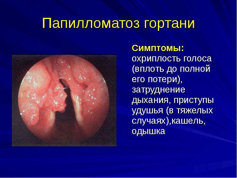   Папилломатоз гортани
 Симптомы: охриплость голоса (вплоть до полной его потери), затруднение дыхания, приступы удушья (в тяжелых случаях),кашель, одышка
