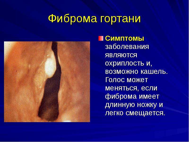   Фиброма гортани
Симптомы заболевания являются охриплость и, возможно кашель. Голос может меняться, если фиброма имеет длинную ножку и легко смещается.
