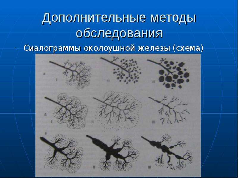 Реактивно дистрофические заболевания слюнных желез. Реактивно-дистрофические воспалительные заболевания слюнных желез.. Сиалограмма слюнных желез. Метод обследование околоушной железы. Схемы сиалограмме при хроническом сиалоадените.