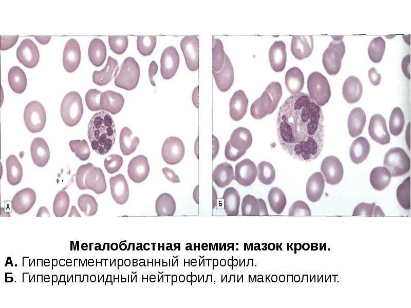 Мегалобластная анемия презентация