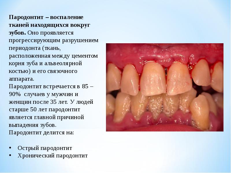 Пародонтит у детей фото