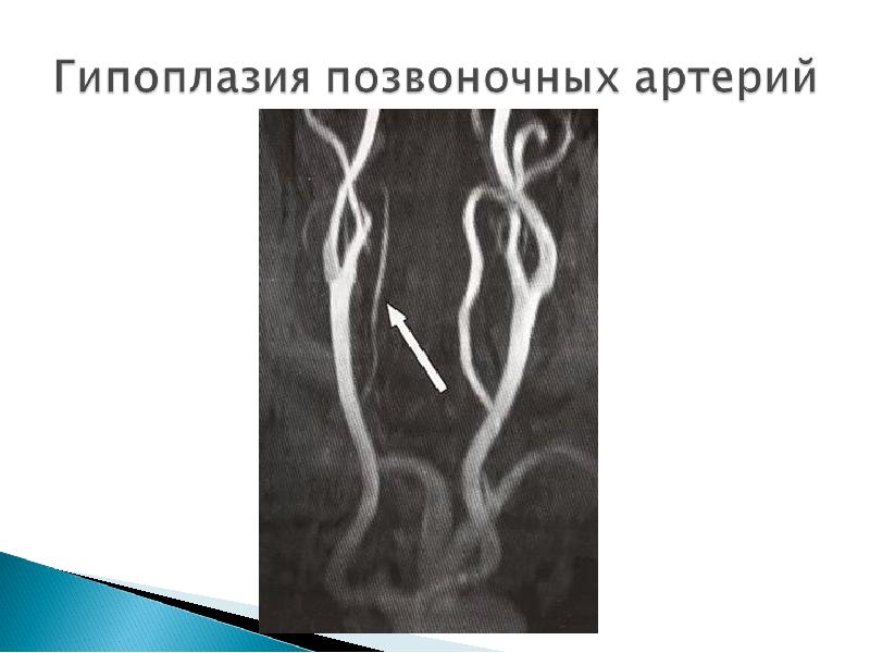 Гипоплазия сегмента v4 позвоночных артерий. Аплазия позвоночной артерии. Гипоплазия v4 сегмента позвоночной артерии. Гипоплазия позвоночной артерии кт.