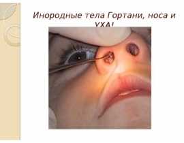 Инородные тела Гортани, носа и УХА