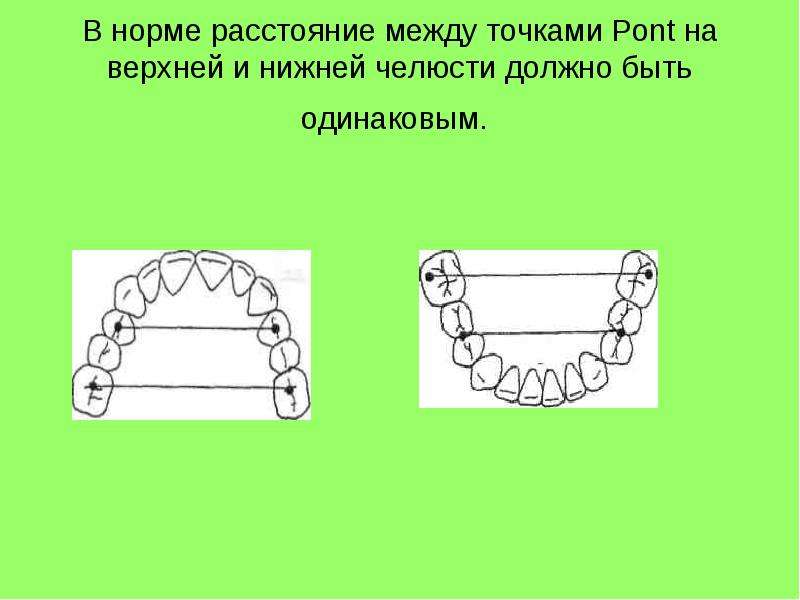 Должны быть одинакового. Расстояние между нижней и верхней челюстью. Презентация диагностика зубочелюстных аномалий. Ширина верхней челюсти между четверками. Резинки соединяющие верхнюю и нижнюю челюсть.