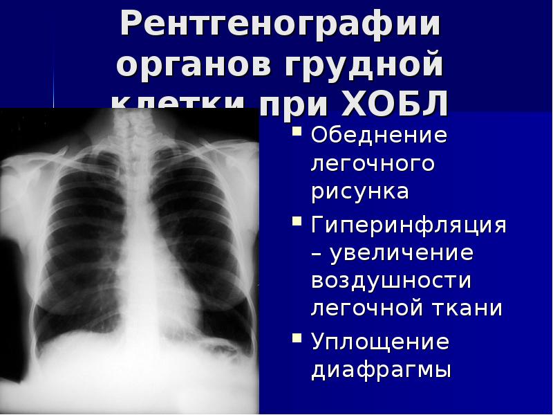 Легочный рисунок рентген. Кт грудной клетки при хроническом бронхите. Легочной рисунок на рентгенограмме. Кт грудной клетки при ХОБЛ. Увеличение легочного рисунка.