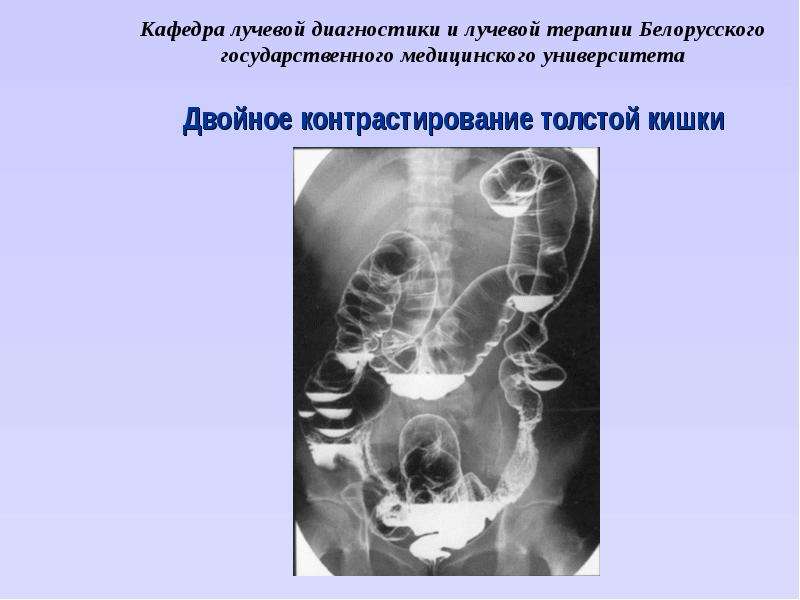 Лучевая диагностика. Метод двойного контрастирования толстой кишки. Двойное контрастирование толстой кишки рентген. Двойное контрастирование Толстого кишечника. Методика двойного контрастирования желудка.