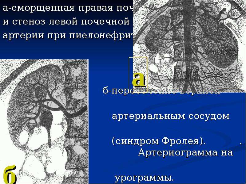 Пиелонефрит презентация патофизиология