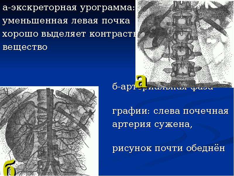 Сосудистый рисунок обеднен. Экскреторные вещества. Экскреторные механизмы почек. Формы экскреторного дерева.