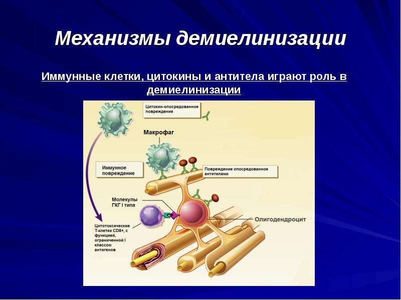 Демиелинизация. Демиелинизация нервных волокон. Миелиновая оболочка демиелинизация. Механизмы демиелинизации. Рассеянный склероз демиелинизация.