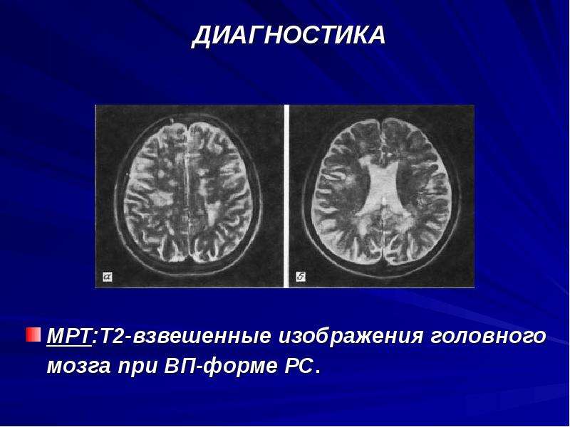 Т1 и т2 взвешенные изображения в мрт