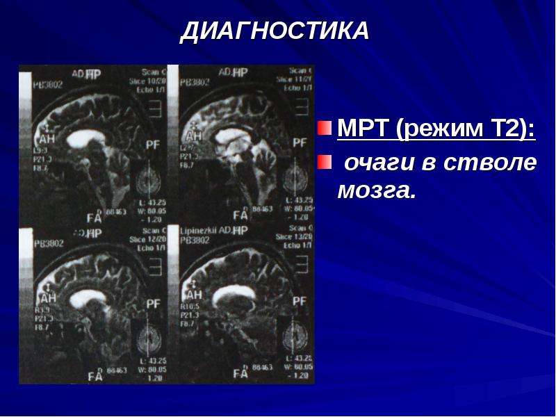 Режимы мрт. Очаг в стволе мозга мрт. Мрт т2 режим. Мрт диагностика образований ствола мозга.