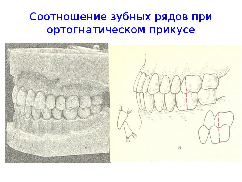 Вид смыкания зубных рядов