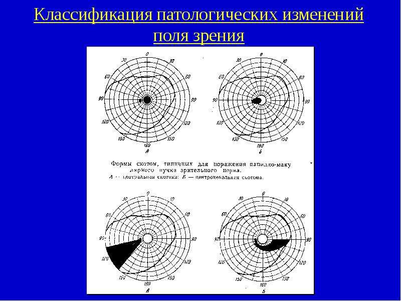 Поли зрения. Периметрия скотомы. Периметрия Центральная Относительная скотома. Центроцекальная скотома. Поле зрения скотома и норма.