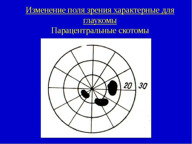 Как изменяется поле зрения. Периметрия скотомы. Скотома Бьеррума. Скотома Бьеррума при глаукоме. Скотомы при глаукоме в поле зрения.