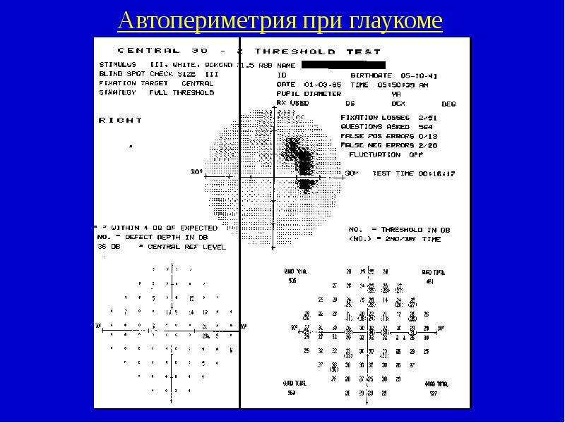 Периметрия расшифровка. Периметрия при глаукоме заключение. Периметрия Хамфри при глаукоме. Периметрия при глаукоме показатели. Кинетическая периметрия при глаукоме.