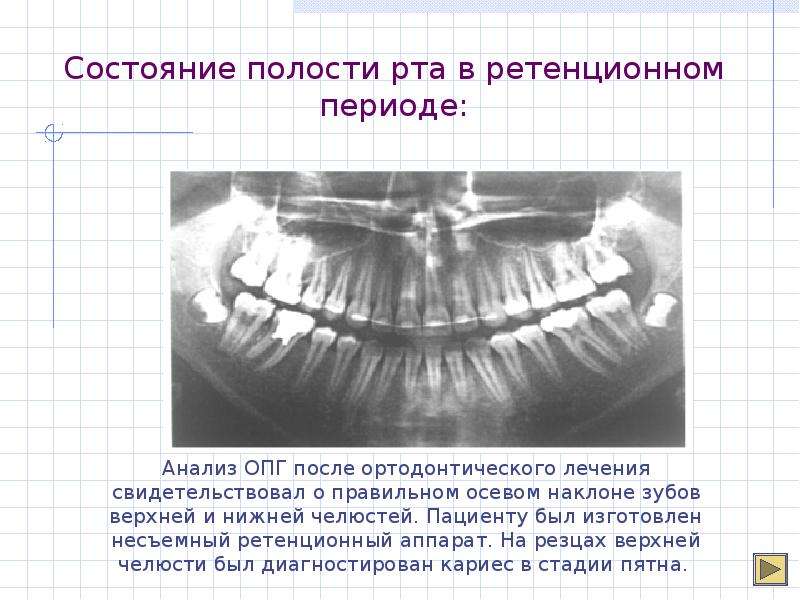 Ретенционные аппараты презентация