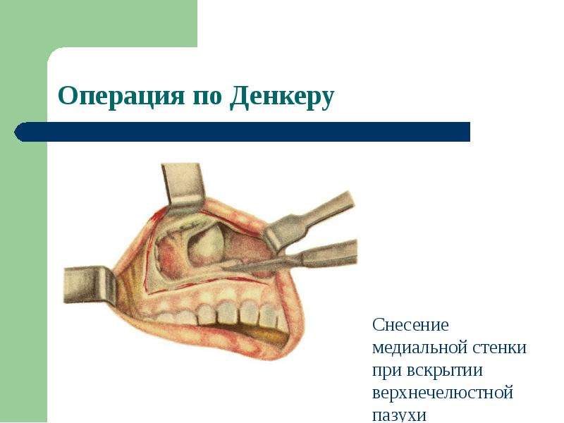 Медиальная стенка верхнечелюстной пазухи