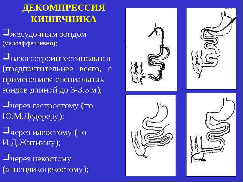 Декомпрессия это. Методы декомпрессии кишечника. Декомпрессия кишечника. Декомпрессия кишечника при перитоните. Методы декомпрессии кишечника при перитоните.