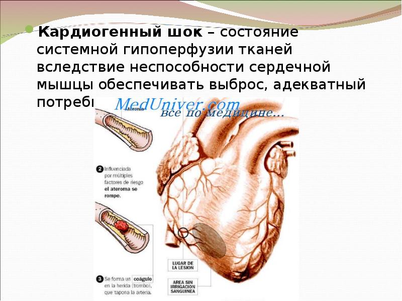 Кардиогенный шок какое давление