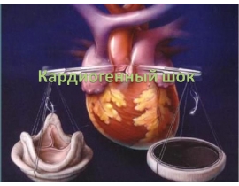 Кардиогенный шок