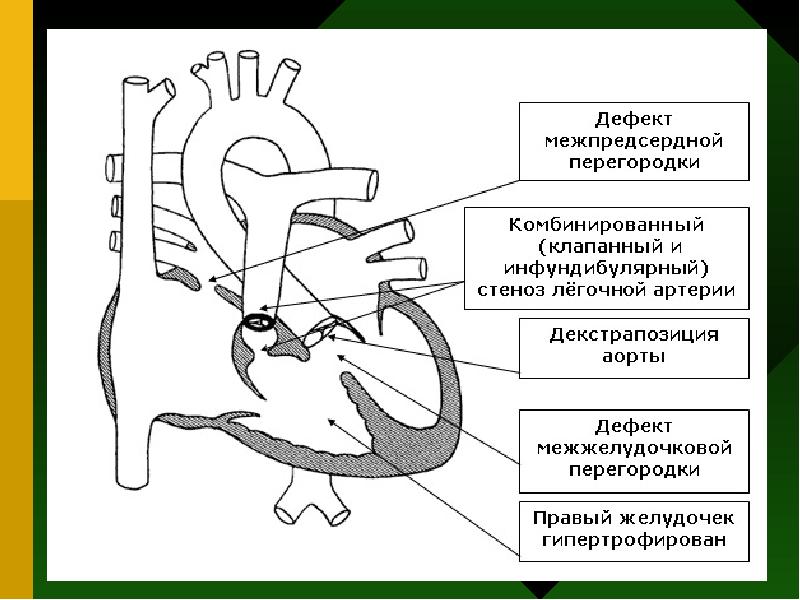 Тетрада фалло клиническая картина