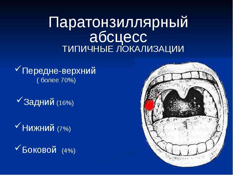 Заглоточный абсцесс карта вызова скорой помощи