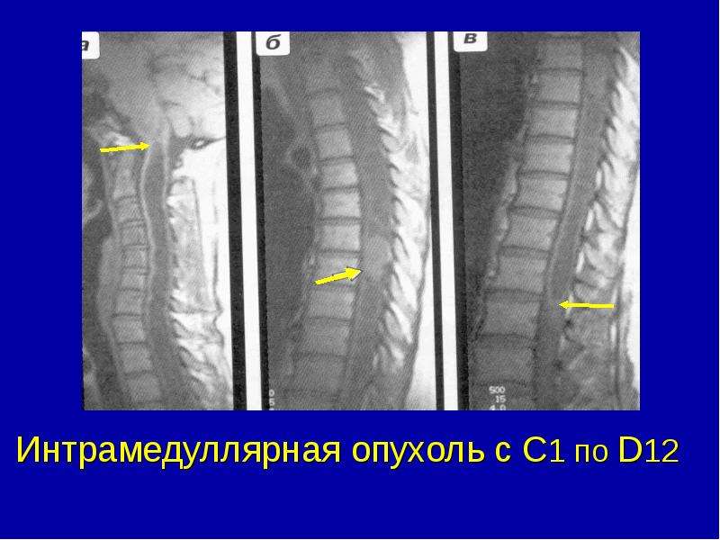 Опухоли спинного мозга презентация