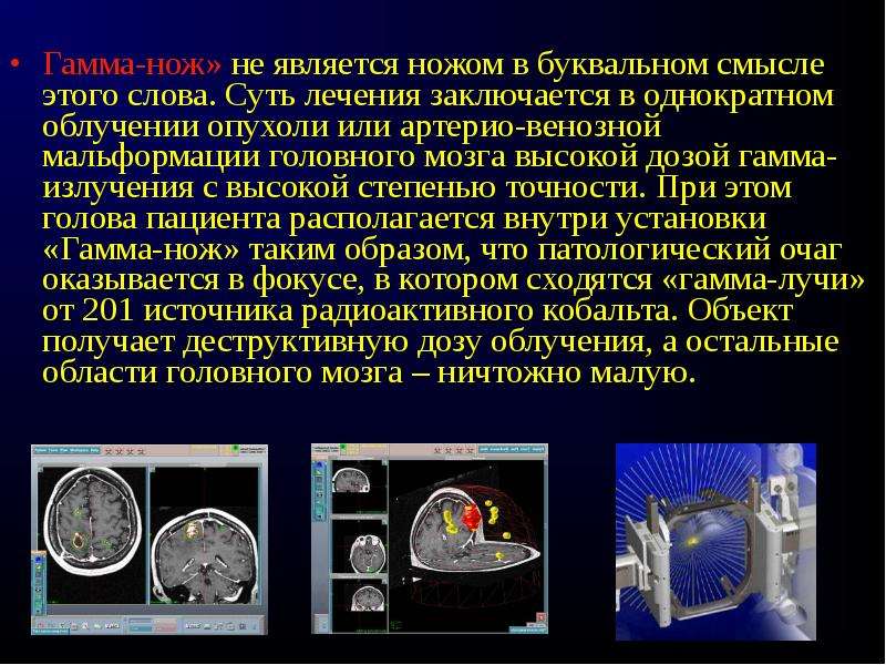 Лучевая терапия опухолей головного мозга презентация