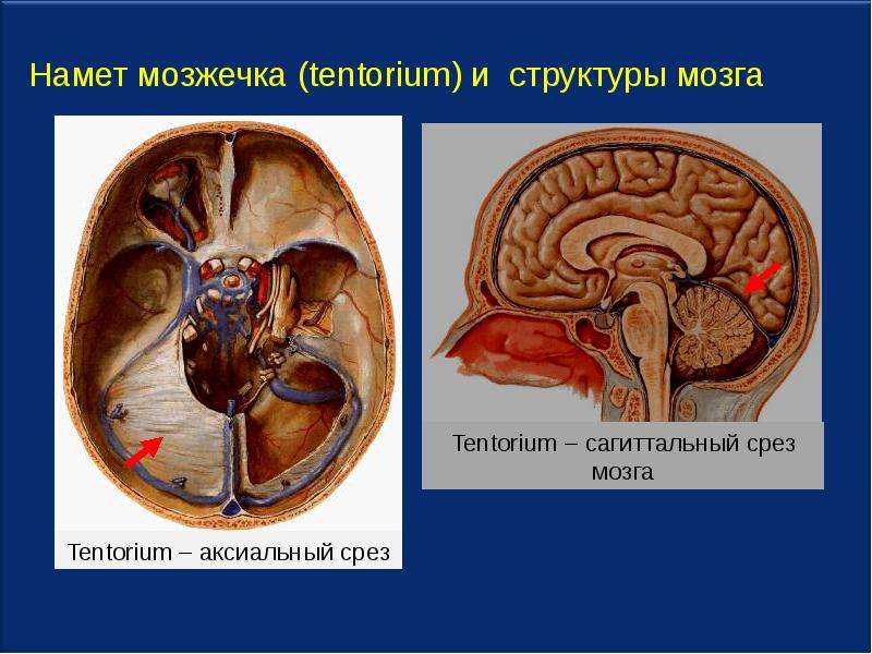 Намет мозжечка анатомия. Твердая мозговая оболочка намет мозжечка. Серп мозжечка анатомия. Новообразование головного мозга под мозговым наметом.