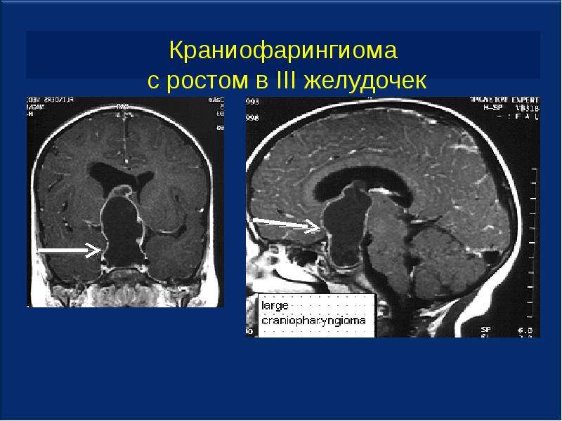 Опухоли головного мозга презентация неврология