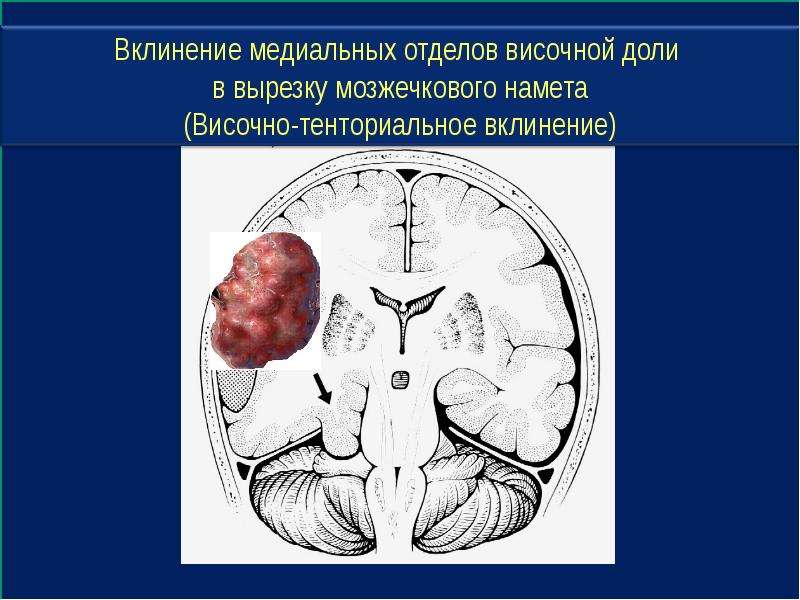 Височный отдел. Височно-тенториальное вклинение головного мозга. Вклинения мозга в тенториальное отверстие.. Вклинение височной доли. Вклинение в вырезку мозжечкового намета.