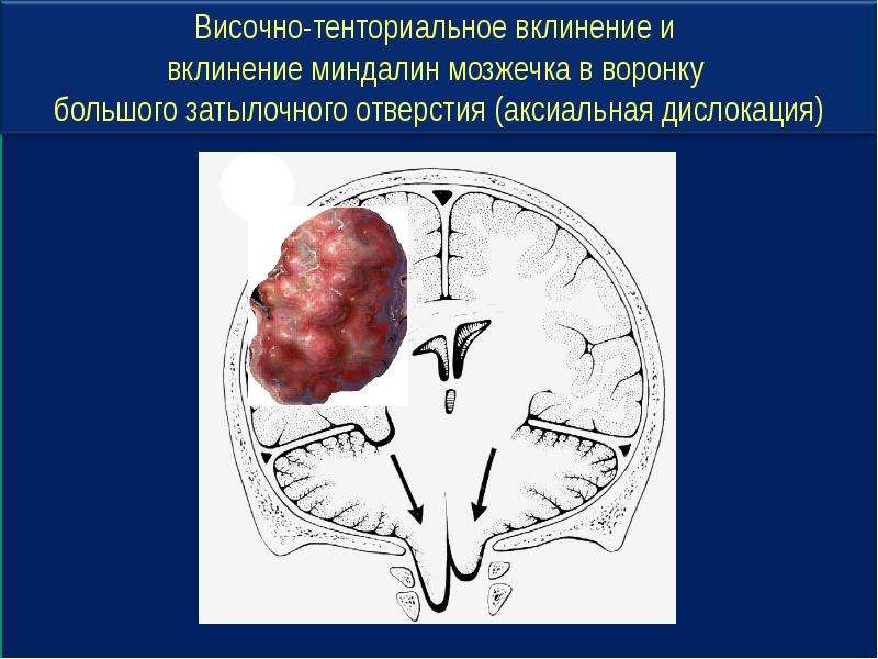 Опухоли головного мозга презентация неврология