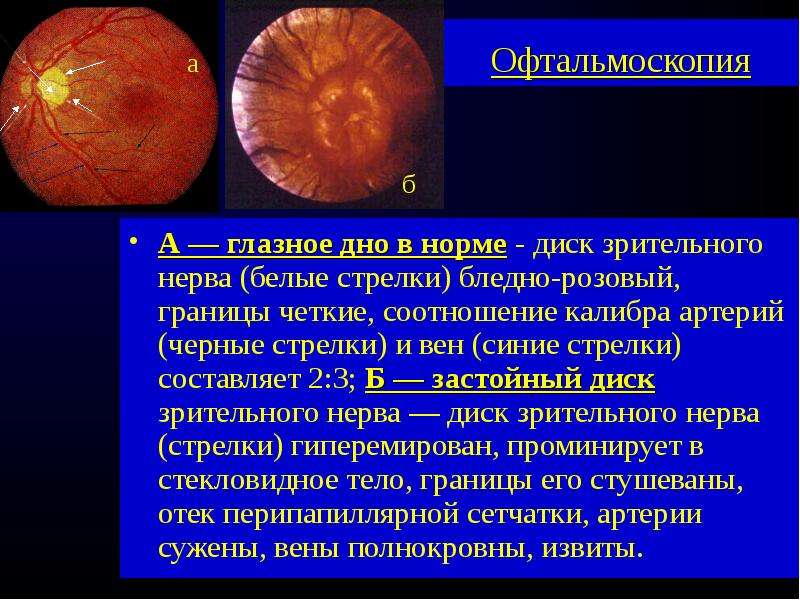 Норма глазного дна. Офтальмоскопия диска зрительного нерва. Диск зрительного нерва на офтальмоскопе. Диск зрительного нерва в норме описание. ДЗН сосуды офтальмоскопия.