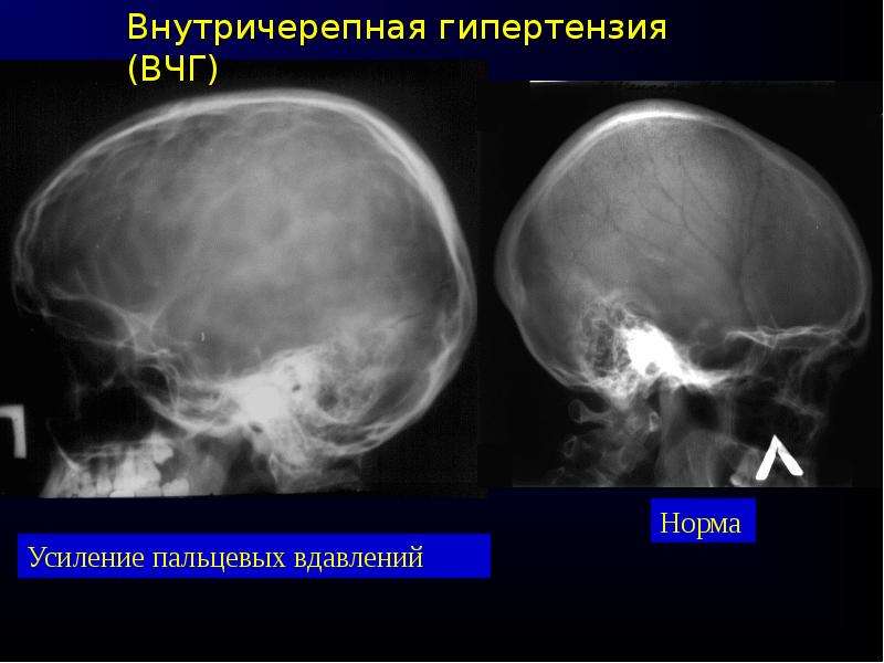 Вчг. Пальцевые вдавления на черепе рентген. Внутричерепная гипертензия. Внутричерепное давление рентген. Рентгенограмма черепа при внутричерепной гипертензии.