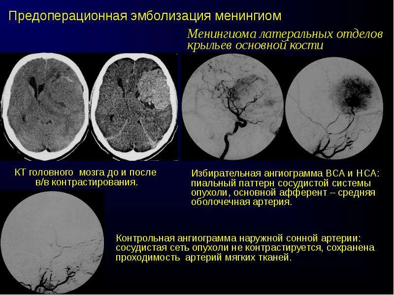 Диагностика опухолей головного мозга презентация