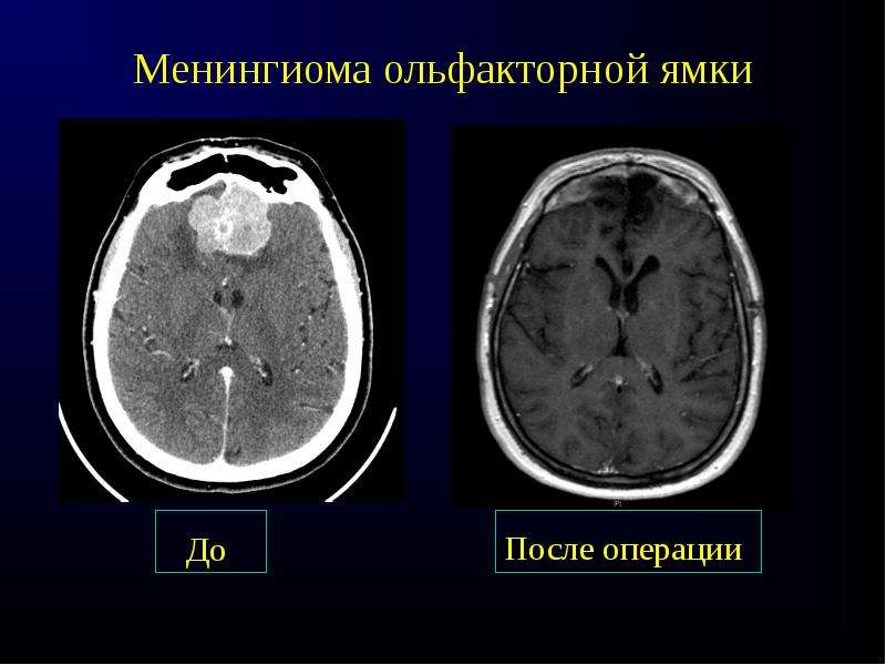 Менингиома головного мозга продолжительность операции. Ольфакторная ямка головного мозга. Менингиома передней черепной ямки. Опухоль головного мозга ольфакторной ямки. Менингиомы мозга на кт.