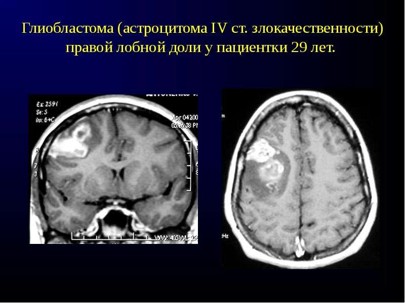 Глиобластома. Глиобластома лобной доли головного мозга. Астроцитома лобной доли.