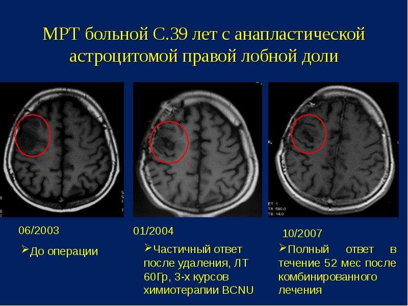 Диагноз опухоли мозга. Анапластическая астроцитома головного мозга. Анапластическая астроцитома головного мозга мрт. Астроцитома головного мозга кт. Опухоль правой лобной доли.