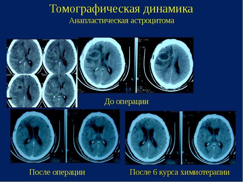 Астроцитома головного мозга прогноз жизни после операции