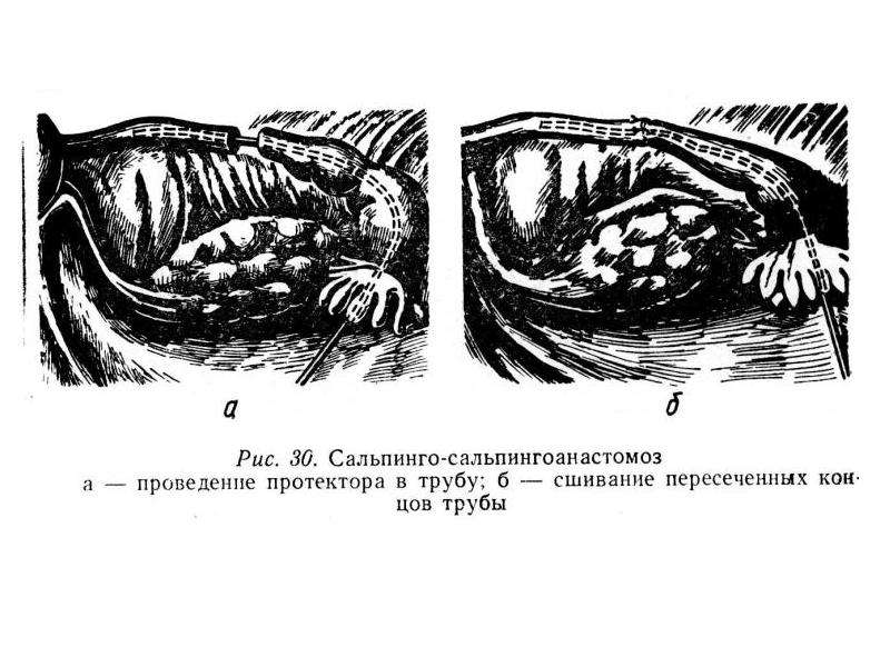 Анатомия малого таза презентация