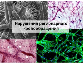 Нарушения регионарного кровообращения