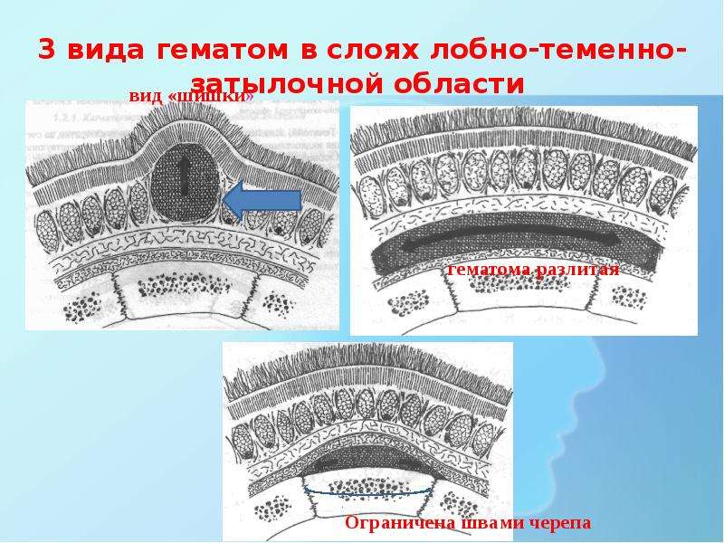 Лобно теменно затылочная область. Гематомы лобно-теменно-затылочной области. Гематома лобно теменно затылочной. Слои лобно-теменно-затылочной области. Клетчаточные пространства лобно-теменно-затылочной области.