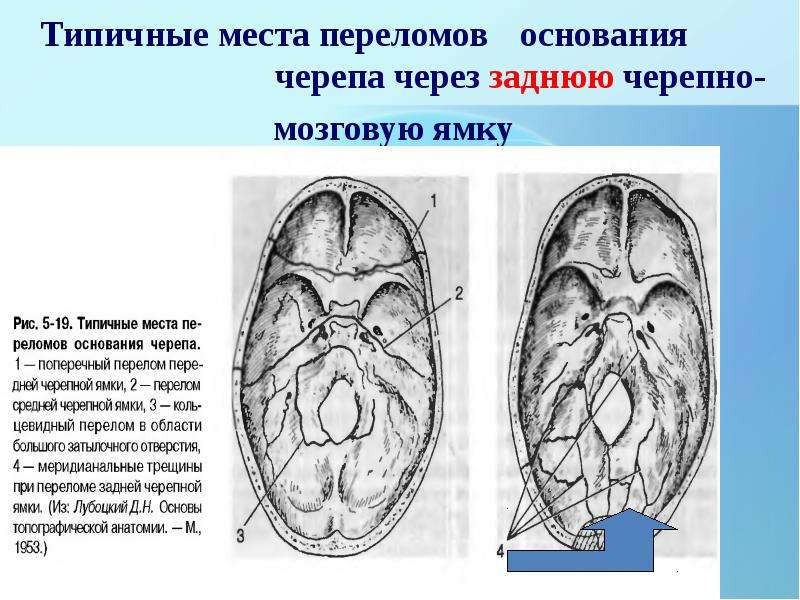 Перелом основания черепа карта вызова