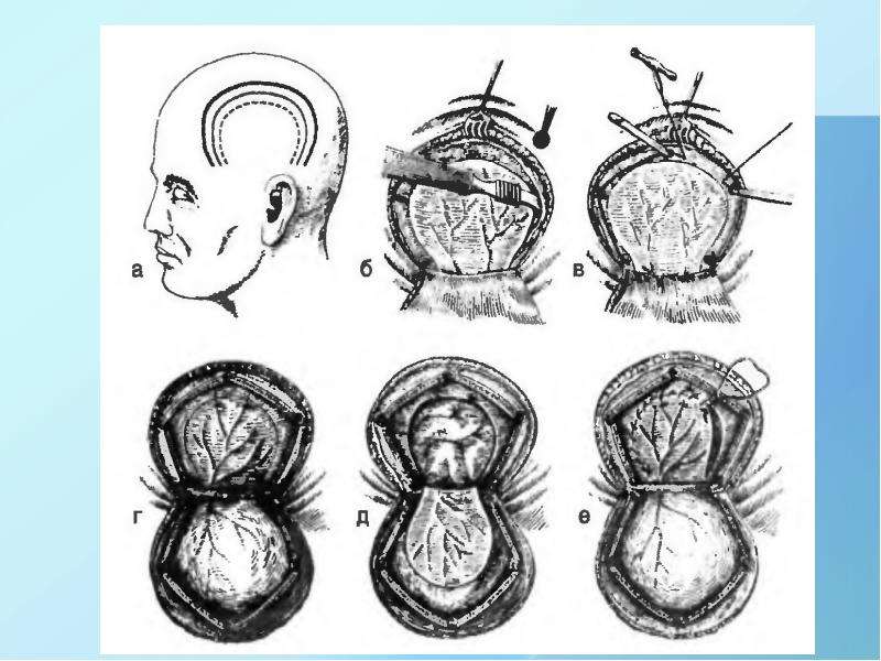 Схема трепанации черепа по способу оливекрона