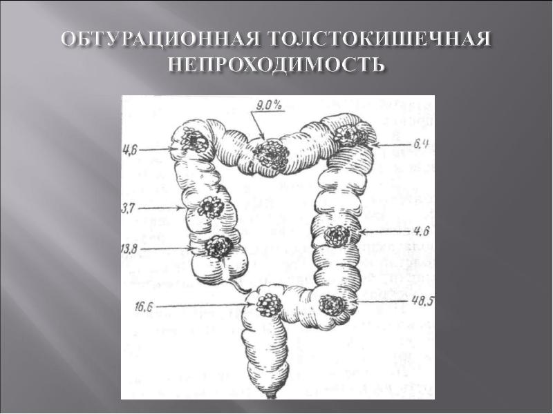 Острая кишечная непроходимость схема