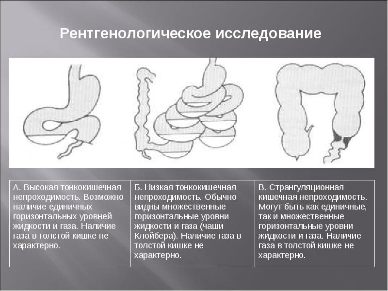 Острая кишечная непроходимость клиническая картина