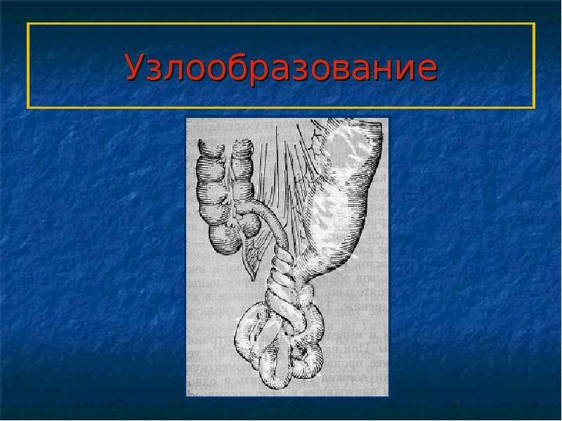 Симптомы непроходимости кишечника. Непроходимость кишечника узлообразование. Странгуляционная кишечная непроходимость. Кишечная непроходимость узлообразование. Ущемление кишечная непроходимость.