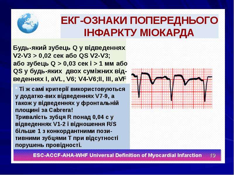 Диагноз миокард. Інфаркт міокарда ЕКГ. Установление ЕКГ. Кости ЕКГ. Происхождение ЕКГ.