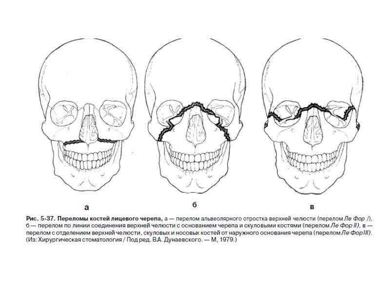 Перелом верхней челюсти картинки